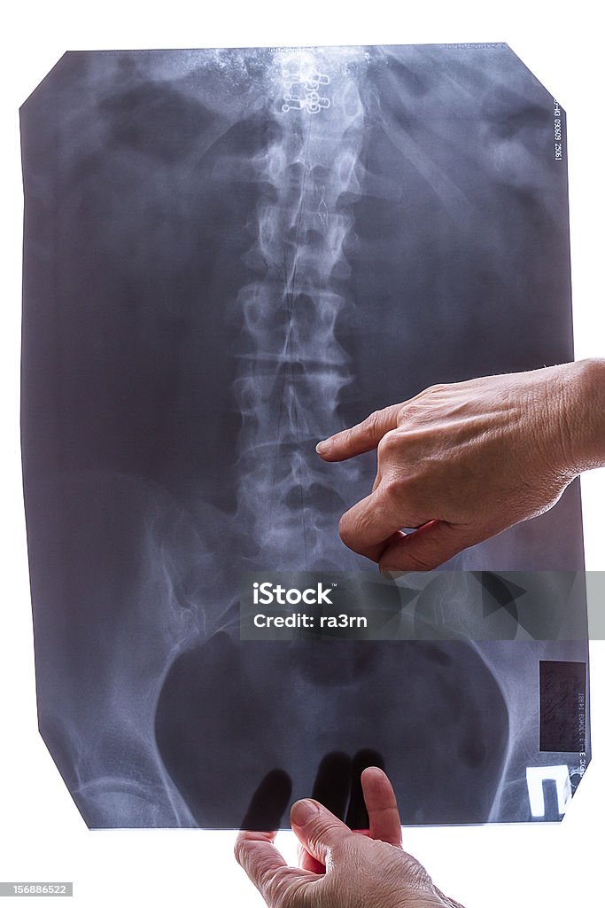 Imagen de rayos X de la columna vertebral - Foto de stock de Anatomía libre de derechos