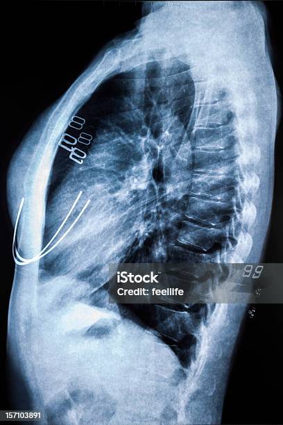 胸 X 線 - X線撮影のストックフォトや画像を多数ご用意 - X線撮影, データ, ヘルスケアと医療