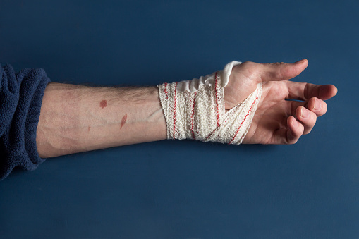 Overhead view of a partially spiral bandaged hand resting on a blue table and showing the remains of a second-degree burn on the forearm and the color change of the skin. First aid and wound healing.