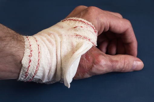 A close-up of a partially spiral bandaged hand resting on a blue table exposing remnants of a second-degree burn in the thumb area. First aid and wound healing.
