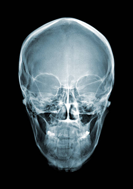 skull xray xray of a skull showing teeth fillings skull photos stock pictures, royalty-free photos & images