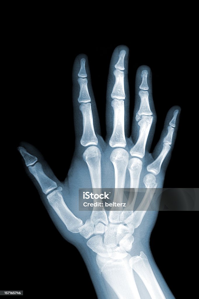 broken hand xray xray of hand showing fractured finger and hand bones X-ray Image Stock Photo