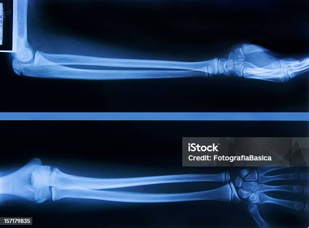 Entrambi I Bracci - Fotografie stock e altre immagini di Gomito - Gomito, Immagine a raggi X, Anatomia umana