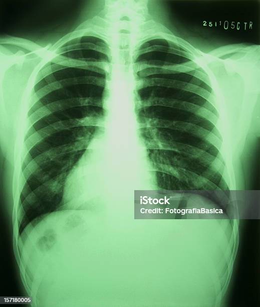 Homer Radiografii - zdjęcia stockowe i więcej obrazów Złamanie - Złamanie, Żebra, Anatomia człowieka