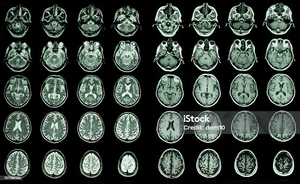 En la MRI del cerebro - Foto de stock de Cerebro libre de derechos