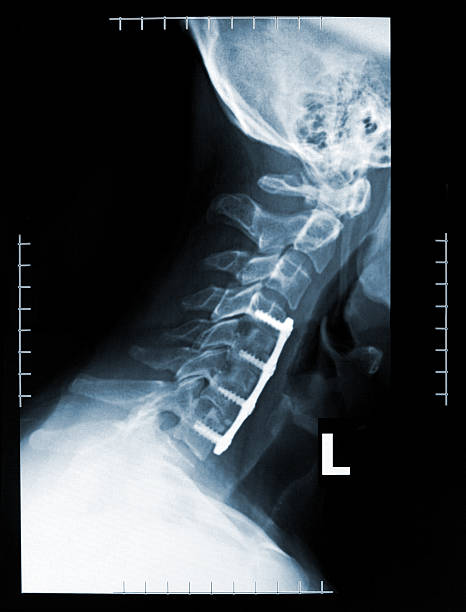 Close-up X-Ray of a pain in the neck stock photo