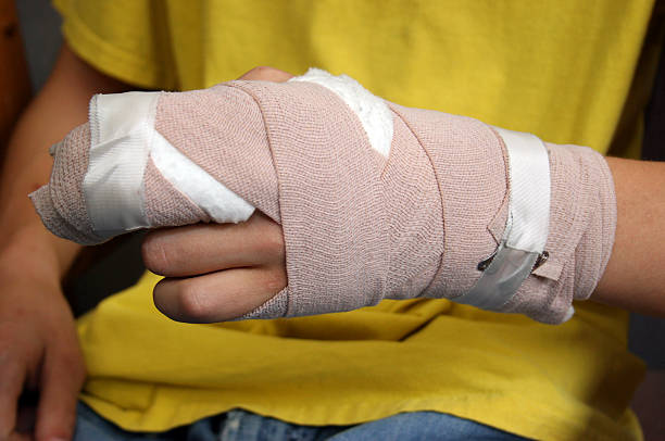 Injured person shows off wrist cast stock photo
