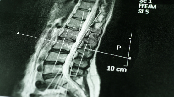 Computerized Tomography of  a spine