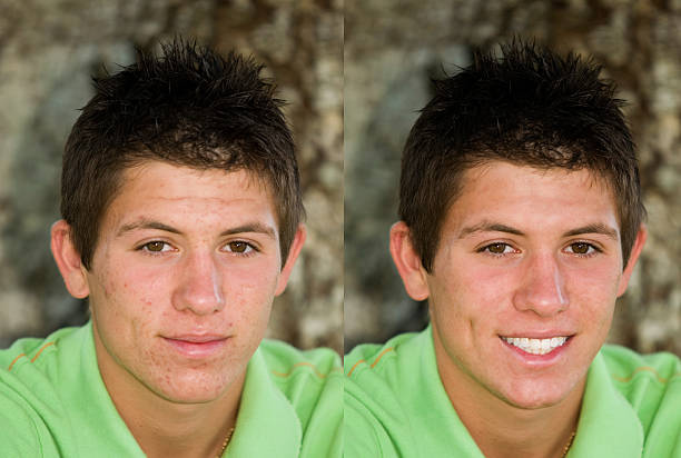 Teen Acne - Before and After stock photo