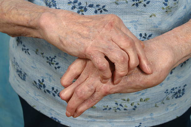 Arthritic Hands- Front, Arthritis Rheumatism stock photo