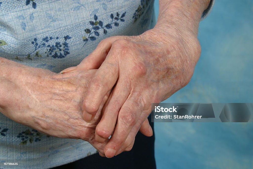 Arthritische Hände Arthritis Rheumatismus - Lizenzfrei Rheumatismus Stock-Foto
