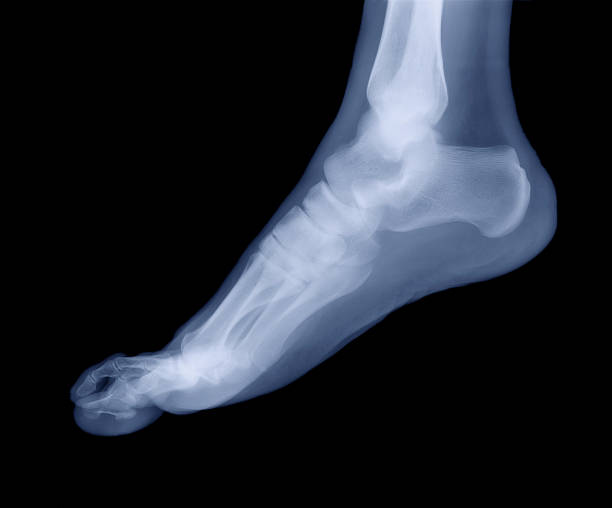 große x-ray - bending human foot ankle x ray image stock-fotos und bilder