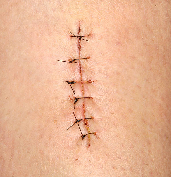 point de suture - stitch photos et images de collection