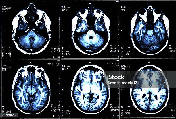 Foto de Exame De Ressonância Magnética e mais fotos de stock de Esclerose Múltipla - Esclerose Múltipla, Exame de ressonância magnética, Cérebro