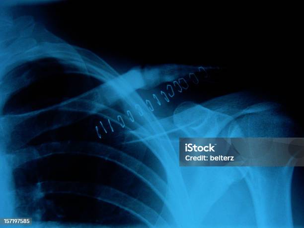 Ouch Xray Stock Photo - Download Image Now - Medical Stitches, Healthcare And Medicine, Medical Exam