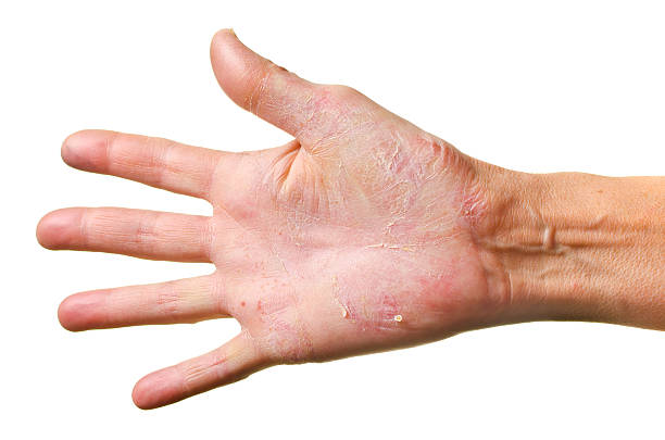 Eczema on a hand Eczema on a hand isolated over white background dermatitis photos stock pictures, royalty-free photos & images
