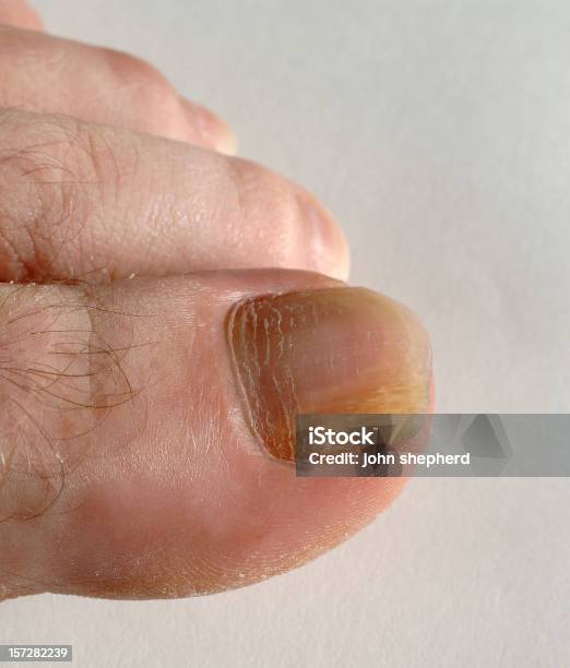 Photo libre de droit de Homme Avec Des Ongles Des Champignons Champignons banque d'images et plus d'images libres de droit de Ongle d'orteil - Ongle d'orteil, Organisme fongique, Onychomycose