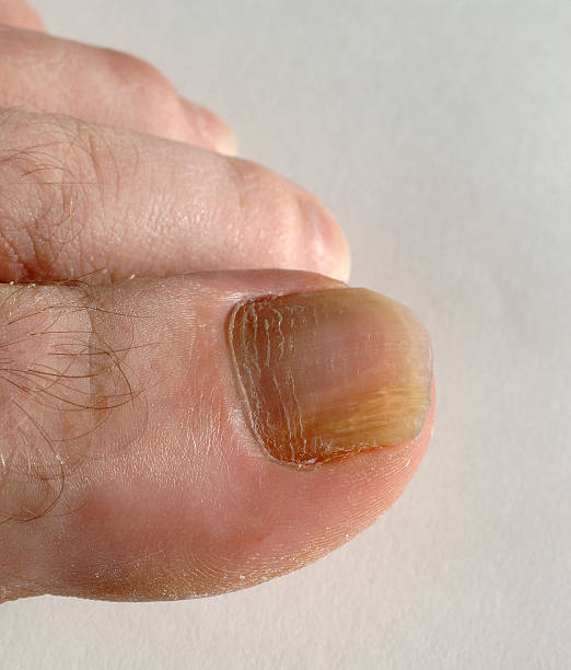 男性のマニキュアにキノコ菌類 - fungus toenail human foot onychomycosis ストックフォトと画像