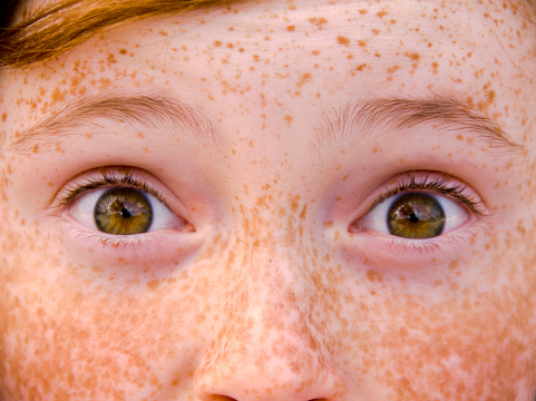 Close up Asian man face with freckles dark spots from uv light , skin care and health problem concept