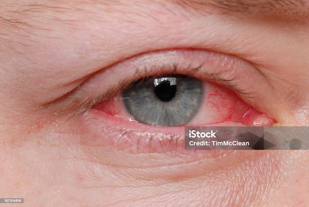 Bindehautentzündung - Lizenzfrei Konjunktivitis Stock-Foto