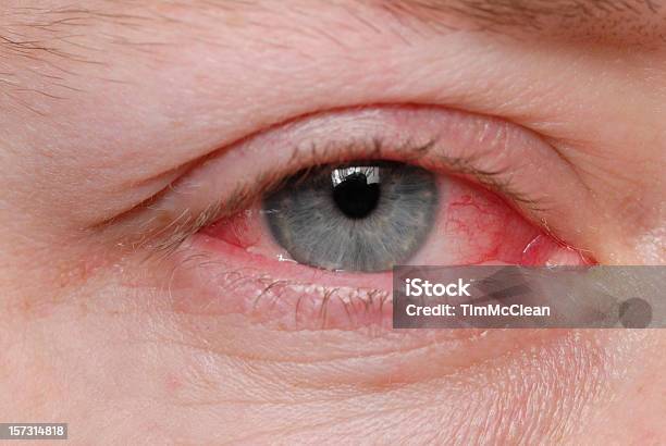 Bindehautentzündung Stockfoto und mehr Bilder von Konjunktivitis - Konjunktivitis, Virus, Blut