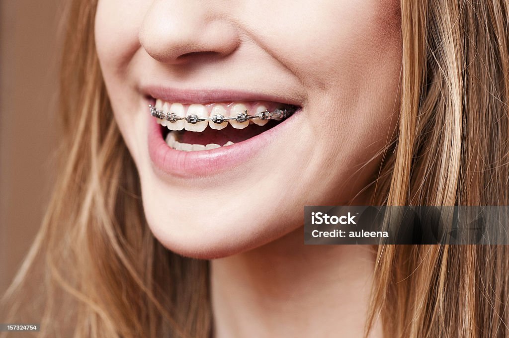 Zähne mit Zahnspange - Lizenzfrei Zahnspange Stock-Foto