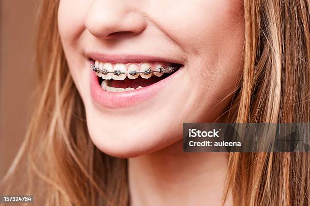 Zähne Mit Zahnspange Stockfoto und mehr Bilder von Zahnspange - Zahnspange, Metall, Teenager-Alter