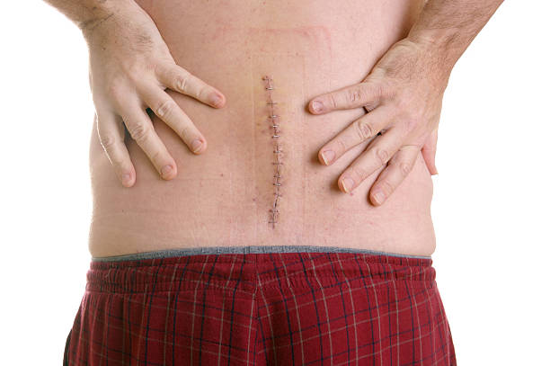 Back Surgery Series Hands on back a classic illustration of back pain demonstrated by a recent back surgery patient, surgical scar with staples in vertical line coccyx photos stock pictures, royalty-free photos & images