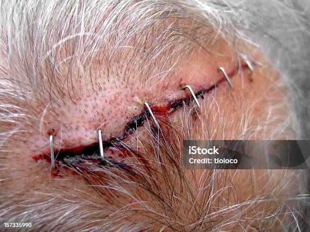 Profundo Da Ferida Scar - Fotografias de stock e mais imagens de Concussão - Concussão, Assustador, Cabelo Humano