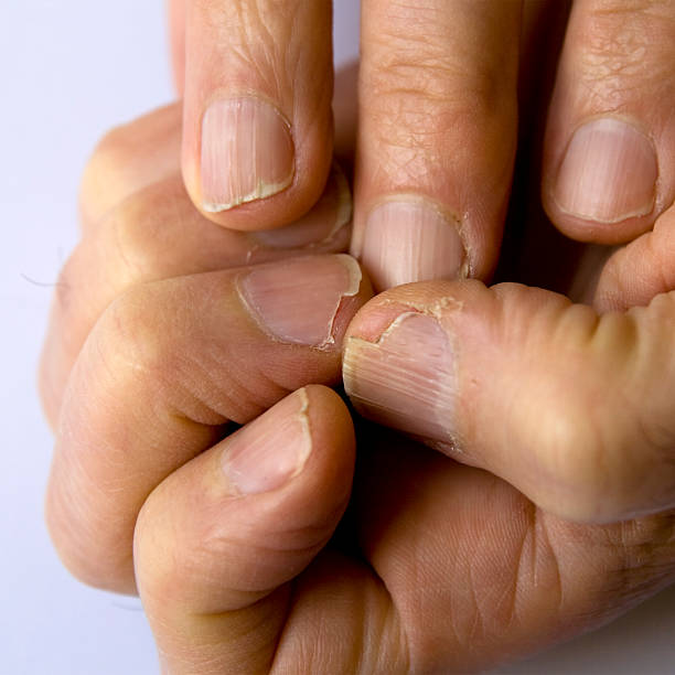 uña de la catástrofe zona - nail biting biting fingernail obsessive fotografías e imágenes de stock