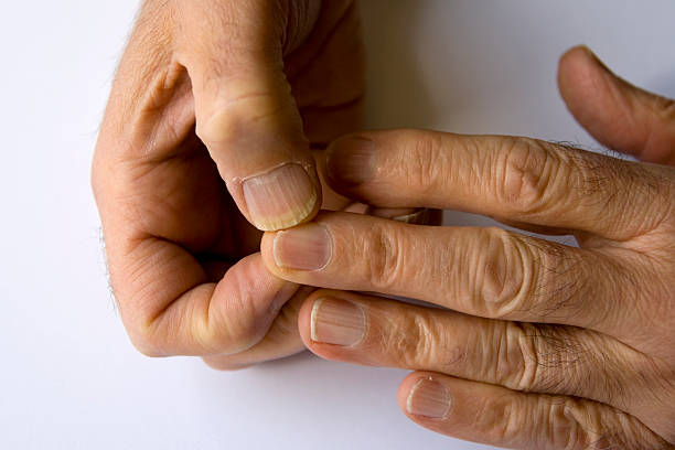 terribile le mani - nail biting biting fingernail obsessive foto e immagini stock