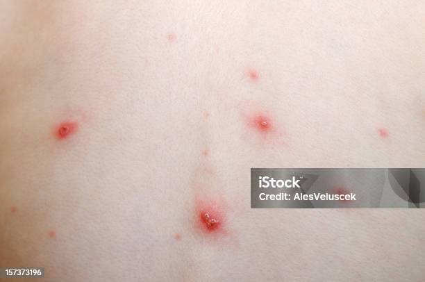 Varicellamalattia - Fotografie stock e altre immagini di Varicella - Varicella, 2000-2009, Allergia