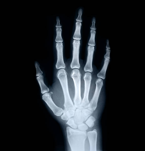 x-ray of human hand - röntgenaufnahme stock-fotos und bilder