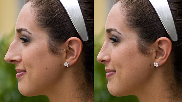 Before and after Plastic Surgery profile pictures of a beautiful hispanic female before and after plastic surgery on her nose. This picture could be very useful for plastic surgery promotional brochures and marketing human nose stock pictures, royalty-free photos & images