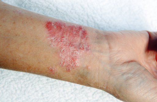 Womans arm with painful skin condition, psoriasis.