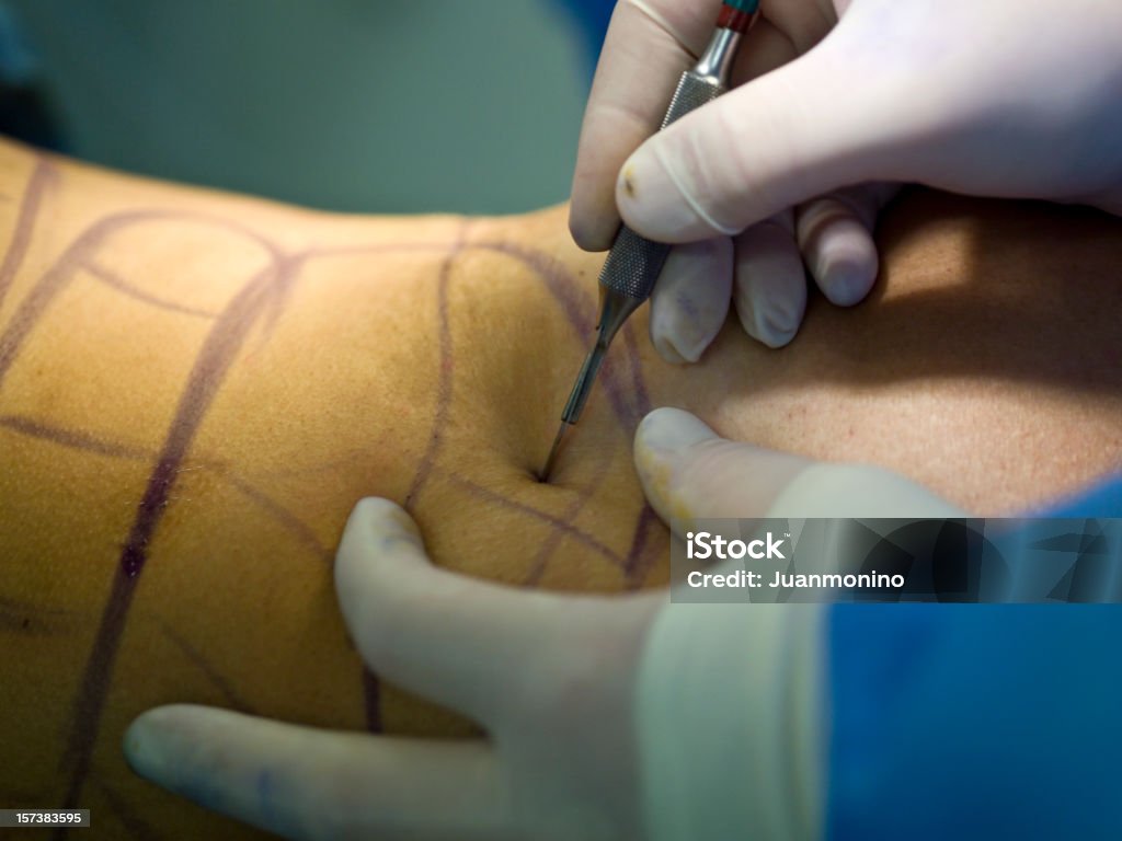 Corte con escalpelo - Foto de stock de Liposucción libre de derechos