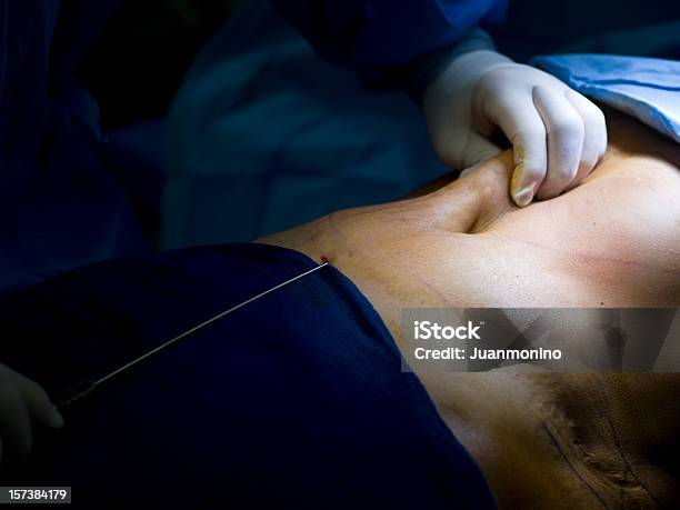 Liposukcja - zdjęcia stockowe i więcej obrazów Liposukcja - Liposukcja, Chirurgia plastyczna, Ciało ludzkie