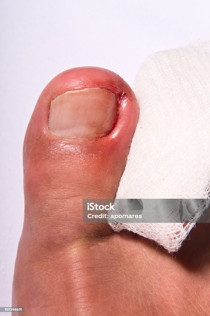 Ingrown uña del dedo del pie - Foto de stock de Unicocriptosis libre de derechos