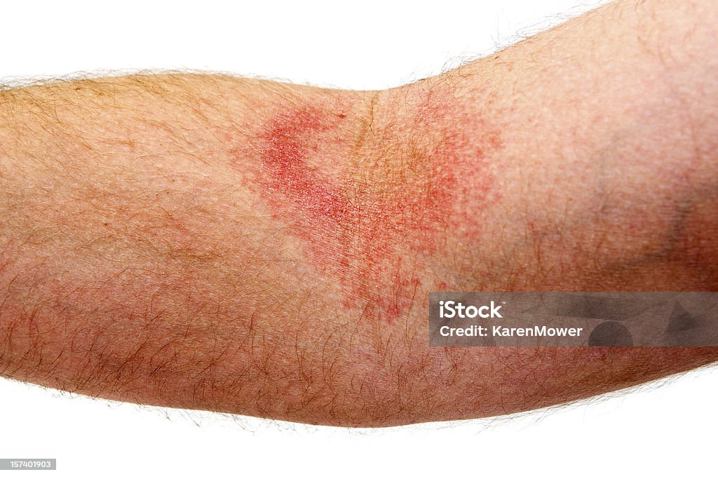 Extravagantes - Foto de stock de Eczema royalty-free