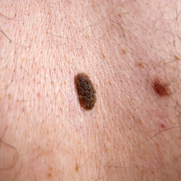 istock Seborrhoeic Keratosis 157419642