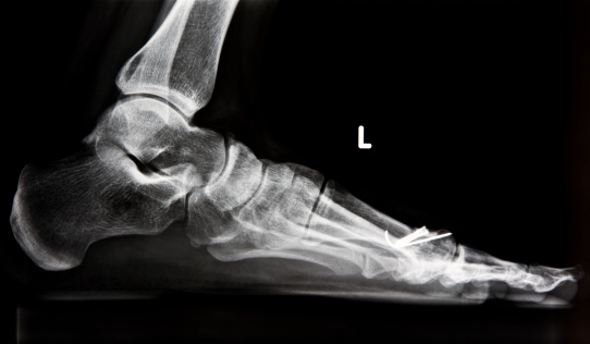 x-ray of human foot,Left foot