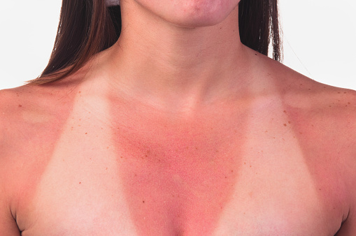 Young woman showing  sun stripes and red skin.