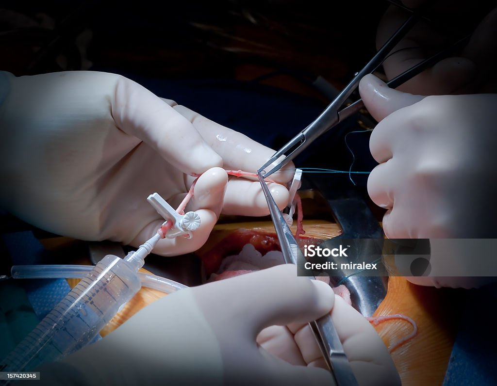 Artère coronaire Bypass Graft chirurgie-cardiaque - Photo de Opération chirurgicale libre de droits