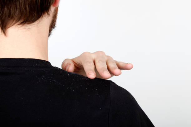 Dandruff Man brushing dandruff off his shoulder. dandruff men stock pictures, royalty-free photos & images