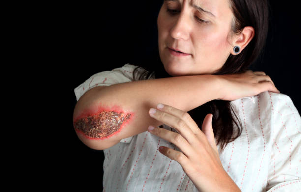 Young Woman with Infected Scab *THIS IS NOT REAL - SPECIAL EFFECTS MAKE UP* Young woman in pain with infected scab on her right elbow. infected wound stock pictures, royalty-free photos & images