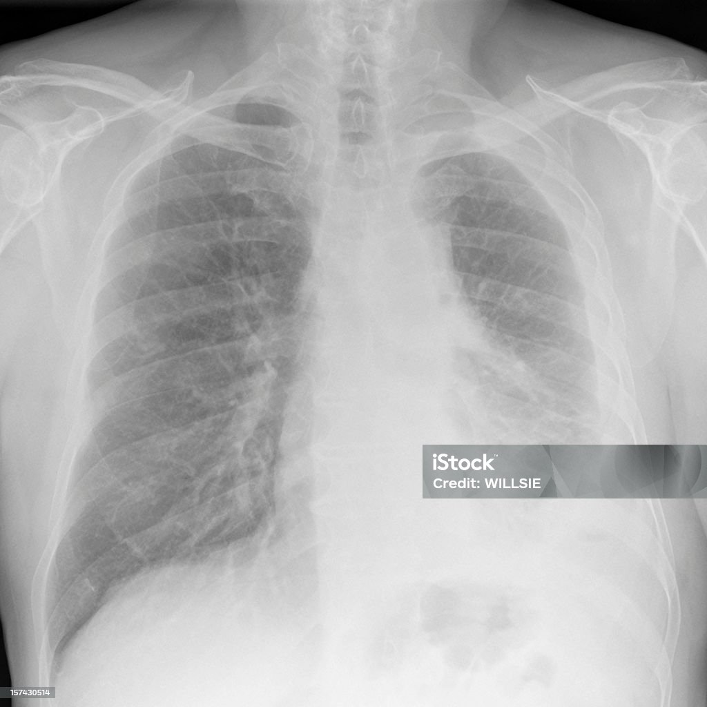 Digital radiografía de tórax de Mesotelioma maligno avanzado sobre la mano izquierda. - Foto de stock de Mesotelioma libre de derechos