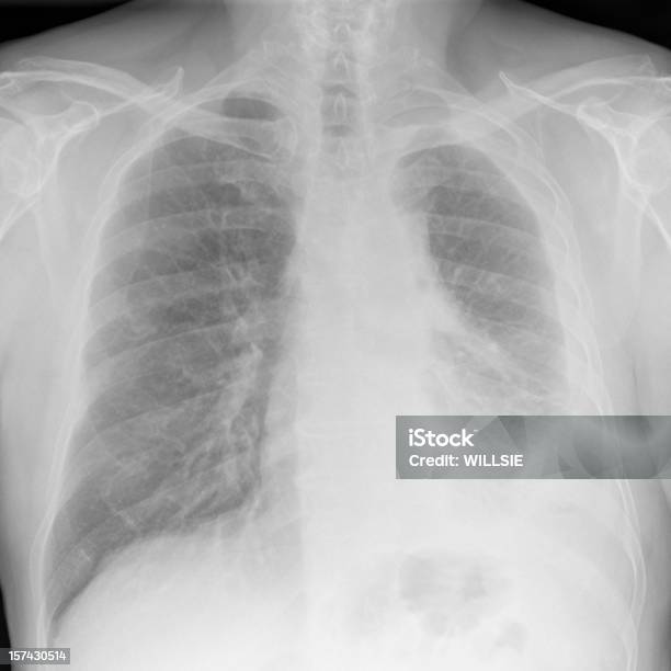 Digital Radiografía De Tórax De Mesotelioma Maligno Avanzado Sobre La Mano Izquierda Foto de stock y más banco de imágenes de Mesotelioma