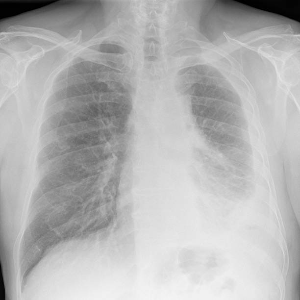 Digital peito raio-x de avançada malignant Mesotelioma à esquerda - foto de acervo