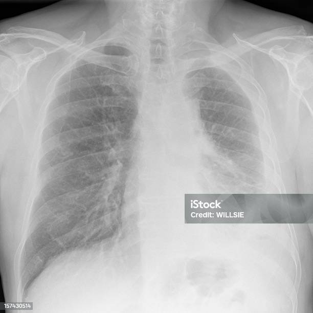Digital Radiografia Torácica De Avançado Malignant Mesothelioma No Lado Esquerdo - Fotografias de stock e mais imagens de Mesotelioma
