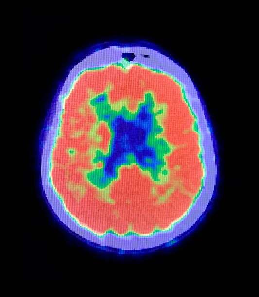 Human Brain PET Scan  pet scan photos stock pictures, royalty-free photos & images
